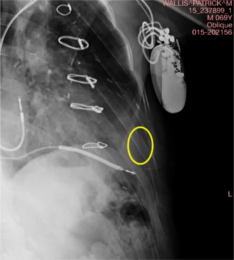 Welcoming old age with a broken rib.